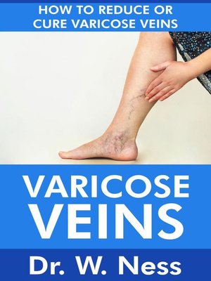 cover image of Varicose Veins